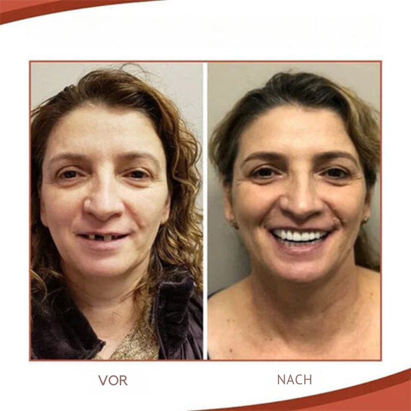 Dental Prosthesis Set – Biocompatible Pain-Free Fit & Natural Smile